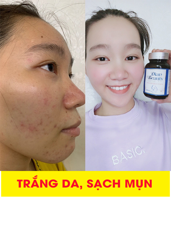 Dian beauty trị mụn